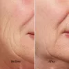 silk'n FaceTite device FTC1PE1001 skin rejuvenation technology – professional facial skin tightening and contouring