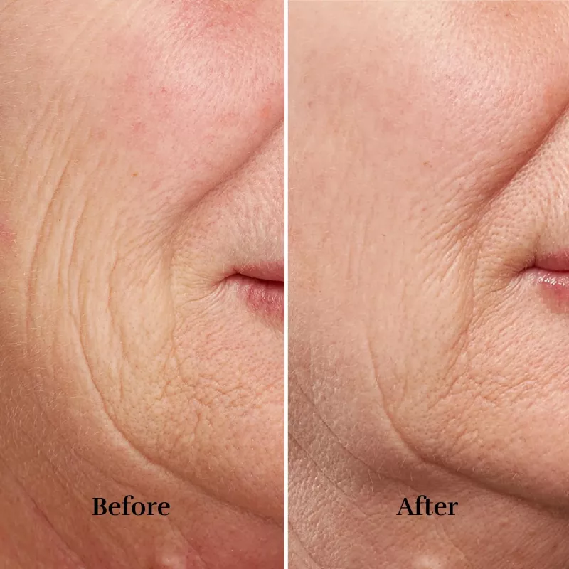 silk'n FaceTite device FTC1PE1001 skin rejuvenation technology – professional facial skin tightening and contouring
